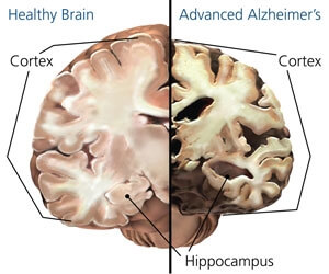 Zmiany w mózgu osoby, którą dotknęła choroba Alzheimera 
