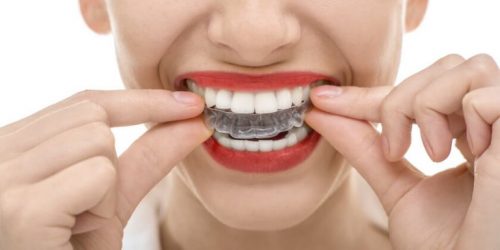 Szyna zabezpieczające zęby