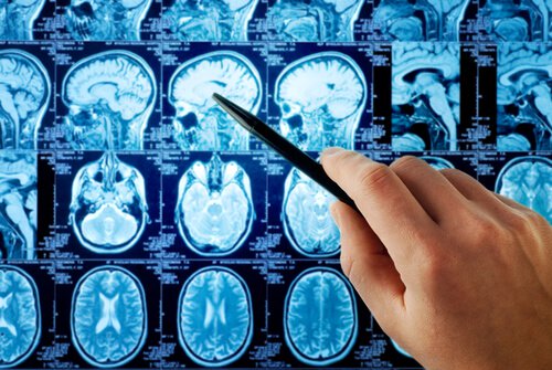 Zdjęcie rentgenowskie mózgu - płat czołowy