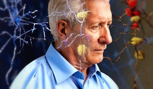 Objawy Alzheimera