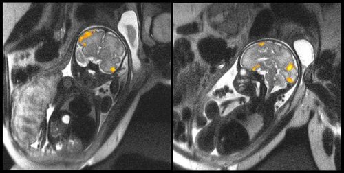 Zdjęcia płodu - obrazowanie aktywności mózgu
