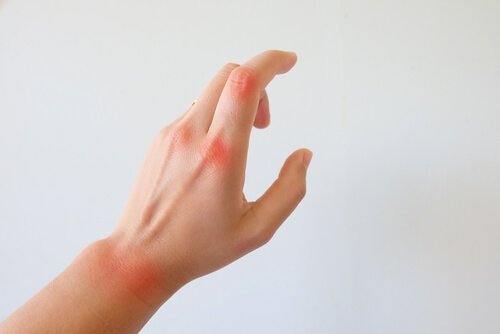 Dłoń - artretyzm reumatoidalny