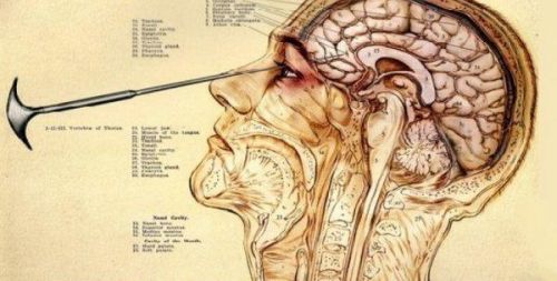 Lobotomia szpikulcem do lodu