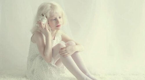 Dziewczynka z albinizmem