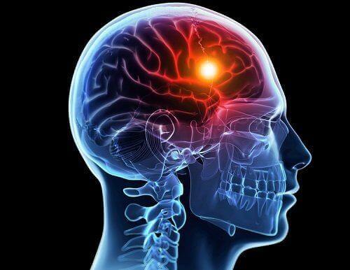 Udar mózgu: poznaj jego przyczyny i rodzaje