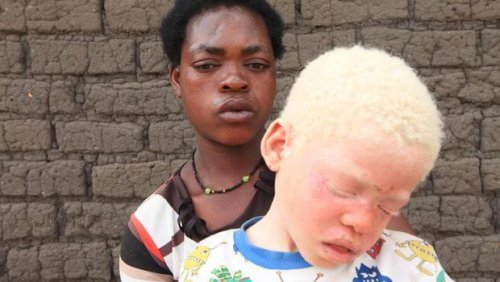 Afrykański chłopiec życie z albinizmem