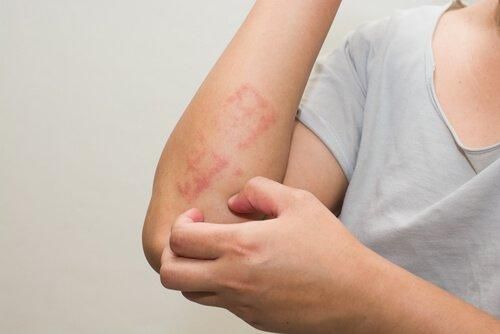 Atopowe zapalenie skóry: 6 sposobów łagodzenia