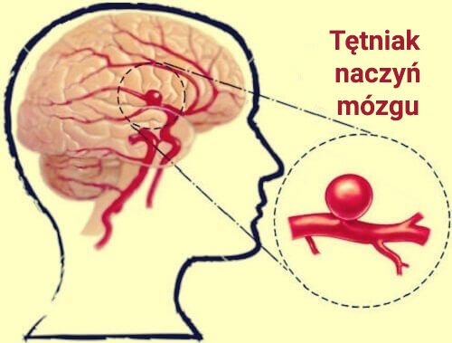 Tętniak naczyń mózgu - dowiedz się czegoś więcej o tej chorobie