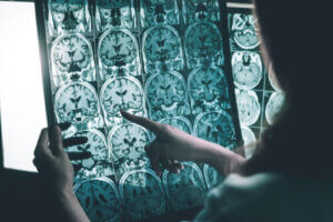 Fale gamma przeciwko chorobie Alzheimera