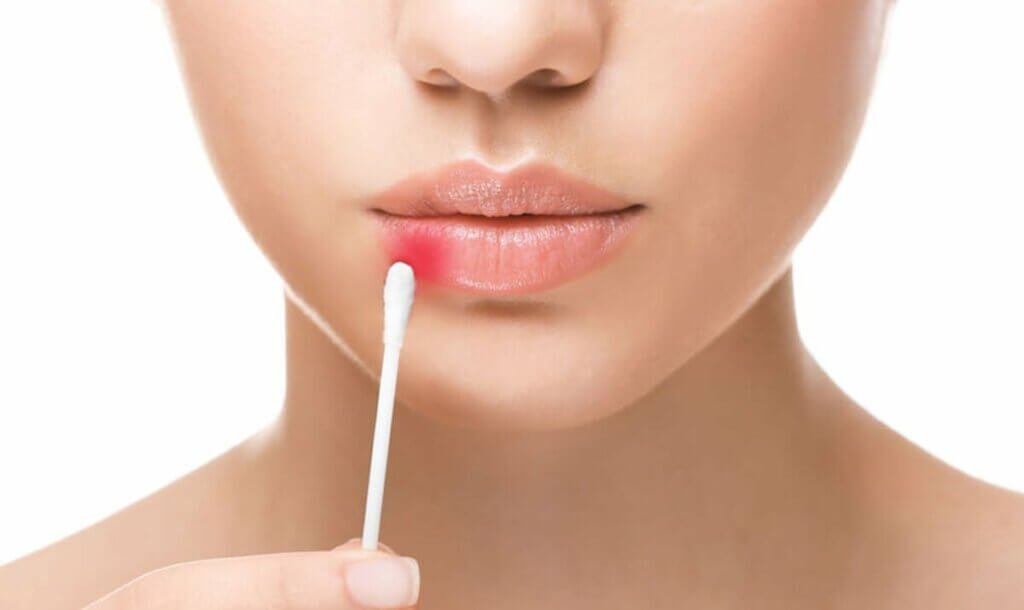 Opryszczka na wargach
